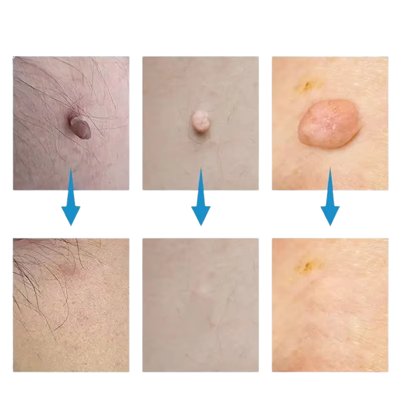 SkinSilence™ komplet za uklanjanje madeža