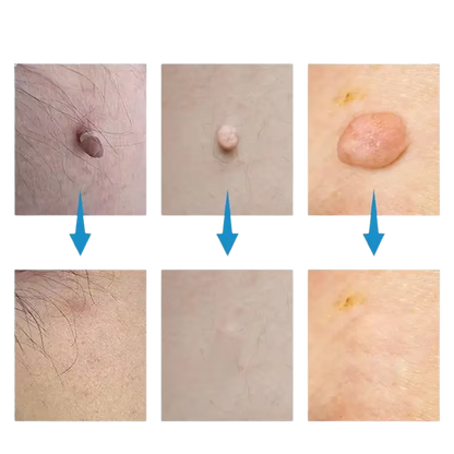 SkinSilence™ komplet za uklanjanje madeža